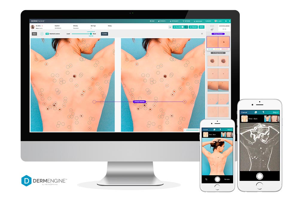 Computer software and mole mapping technology, Dermengine is used by a doctor to check skin for changes in skin spots that may indicate skin cancer in a patient.