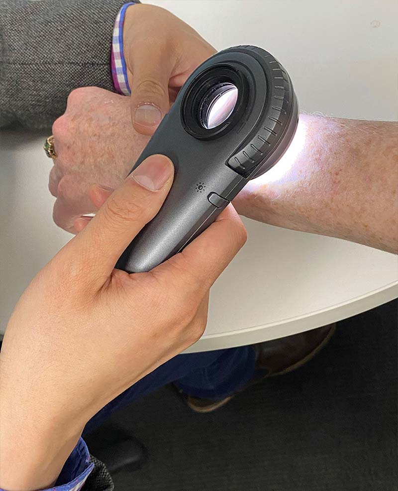 A skin doctor examines moles on the arm of a patient using a a dermatoscope