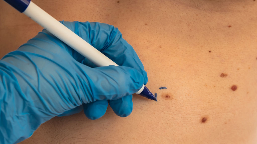 GP marking a mole for surgical removal. Learn about professional mole removal procedures at our medical clinic in Prahran, Melbourne.